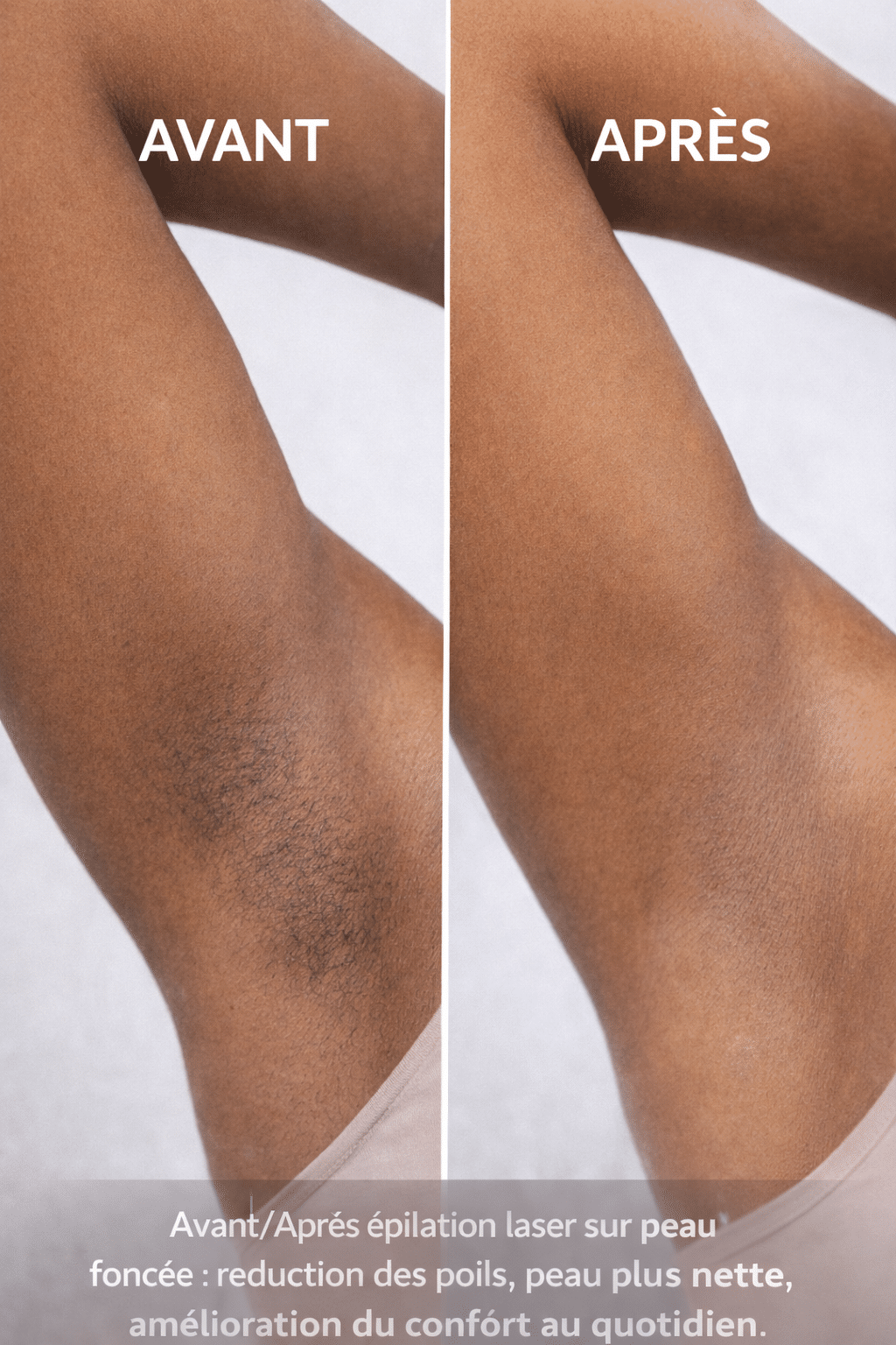 Comparaison avant et après une épilation laser sur peau foncée montrant une réduction visible des poils, une peau plus nette et plus homogène après plusieurs séances.